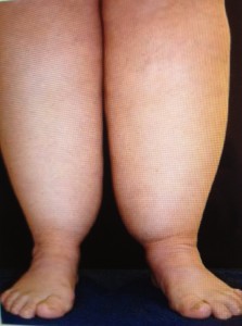 showing no swelling in the ankle`s and feet